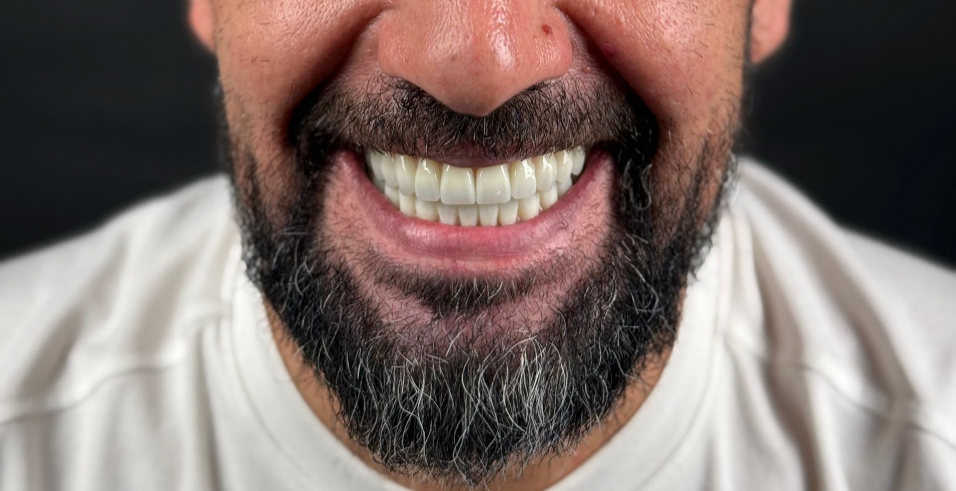 Caz cu atrofie osoasă rezolvat la MD Dental Pitești, rezultat după tratament