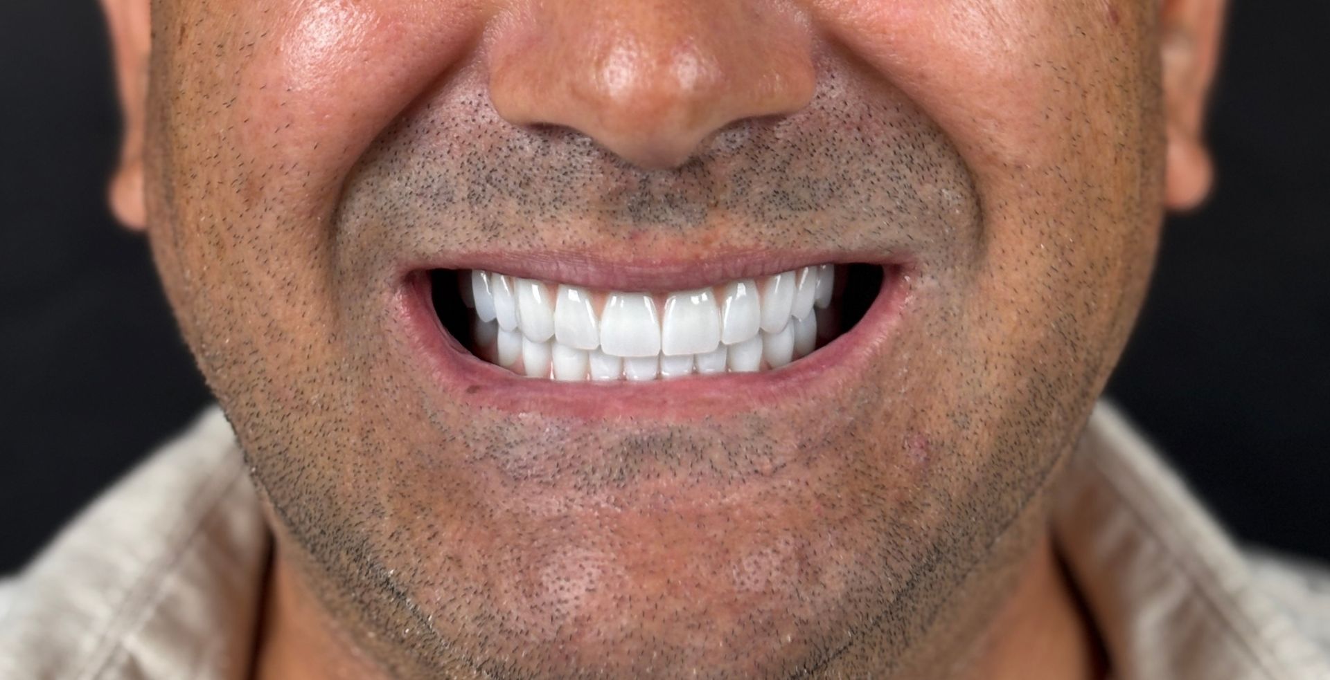 Rezultat tratament dental la MD Dental Pitești