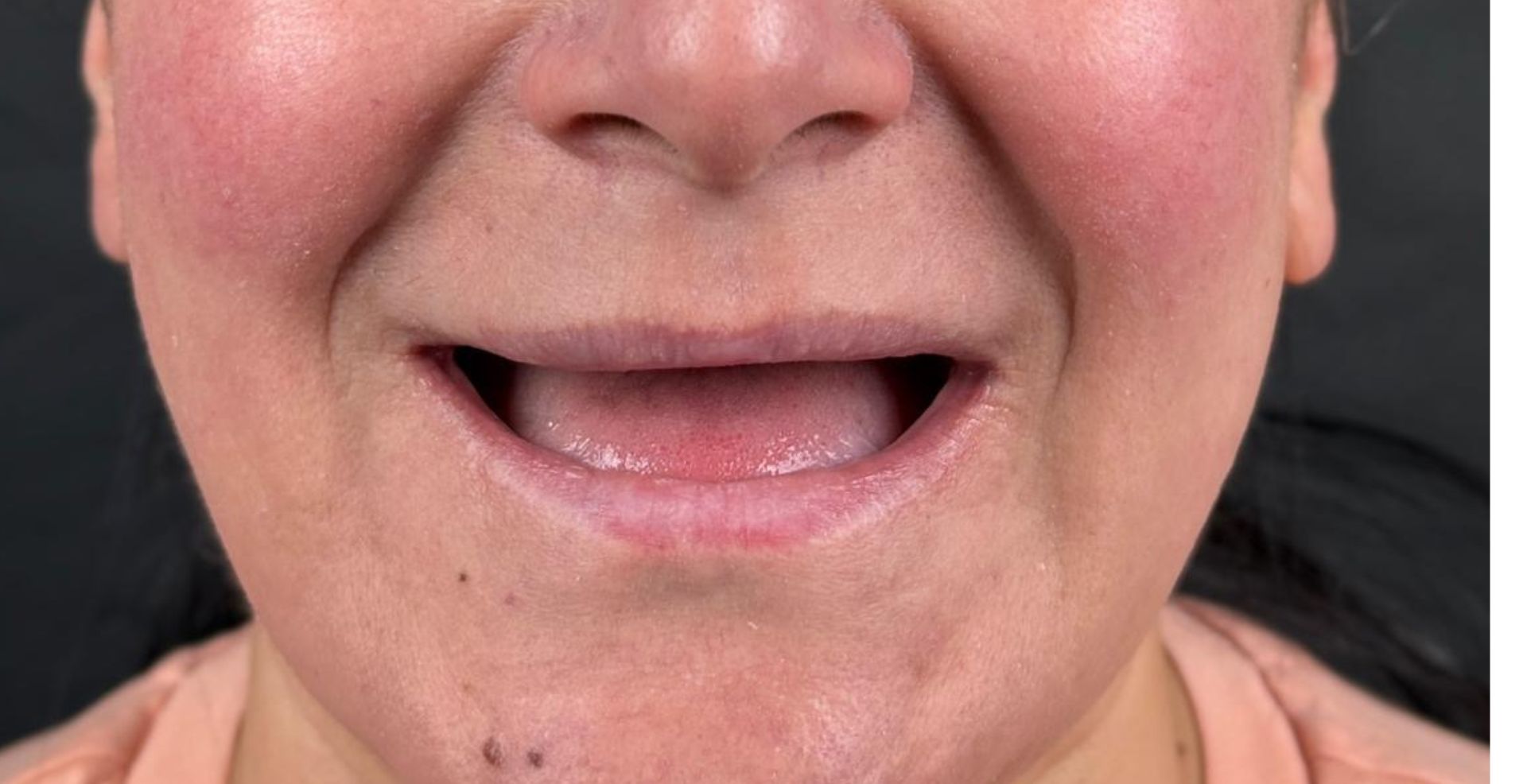 Reabilitare arcadă cu implanturi la MD Dental Pitești, înainte de tratament