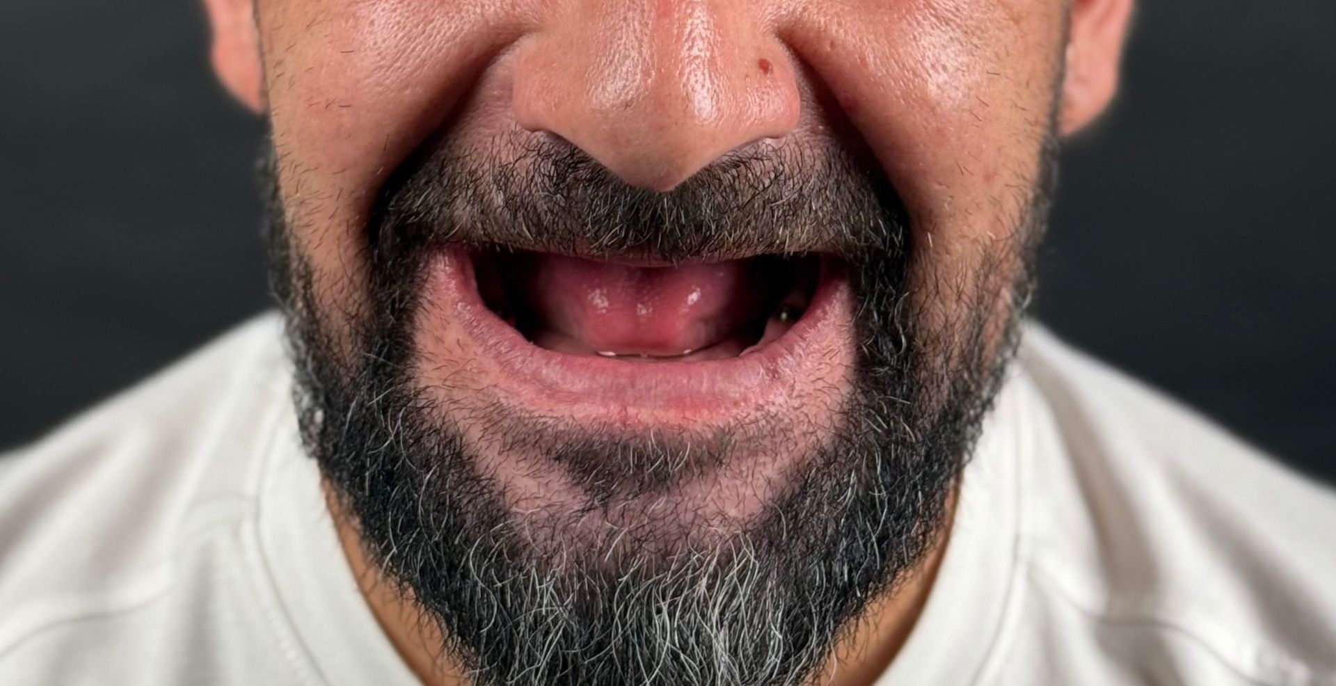 Caz cu atrofie osoasă la MD Dental Pitești, înainte de tratament
